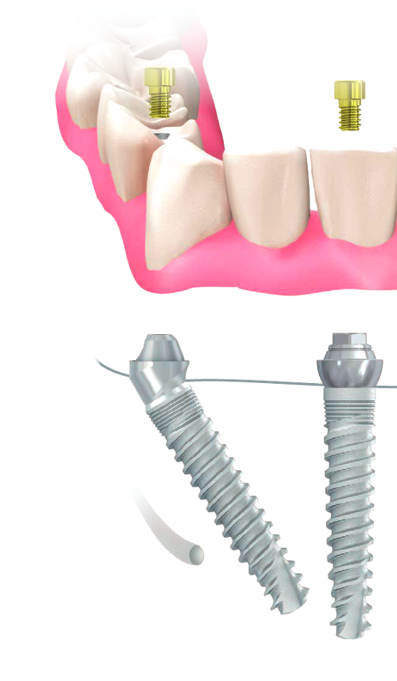 Схема протеза All on 4 протез all on 4